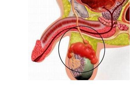 附睾炎的临床表现有哪些