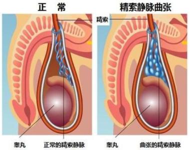 精索静脉曲张应该如何治疗