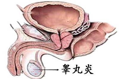 睾丸炎的并发症有哪些