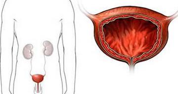 怎么预防膀胱炎