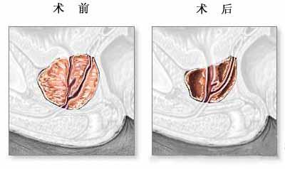 老人患了前列腺增生怎么治