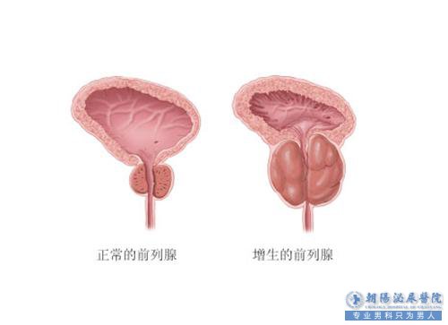 前列腺增生的危害