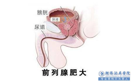 内蒙古大连呼和浩特男科医院-前列腺肥大